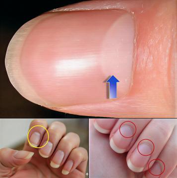 Tırnaklarınızdaki Dikey Çizgiler