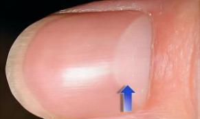 Tırnaklarınızdaki Dikey Çizgiler