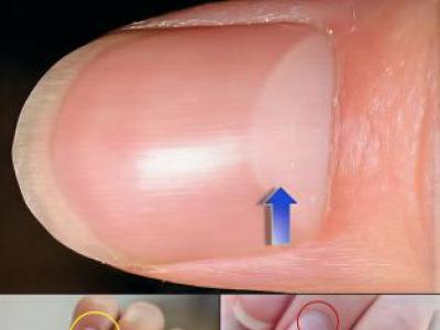 Tırnaklarınızdaki Dikey Çizgiler