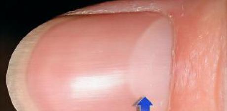 Tırnaklarınızdaki Dikey Çizgiler