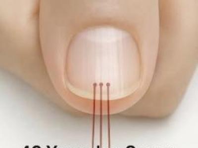 Tırnaklarınızdaki Dikey Çizgiler Size Ne Anlatıyor 