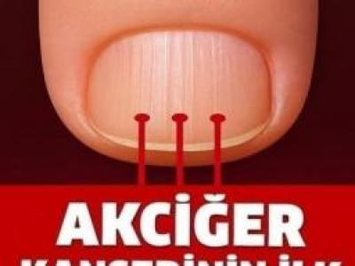 Akciğer Kanserinin En Sinsi 9 Belirtisi