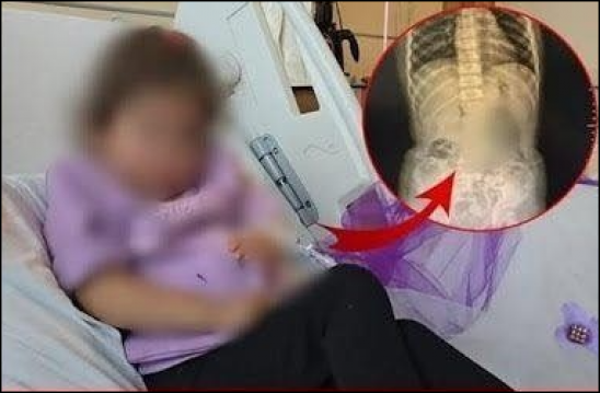 4 Yaşındaki Küçük Kızın bağırsağın dan çıkanlar