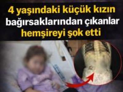 4 Yaşındaki Küçük Kızın bağırsağın dan çıkanlar
