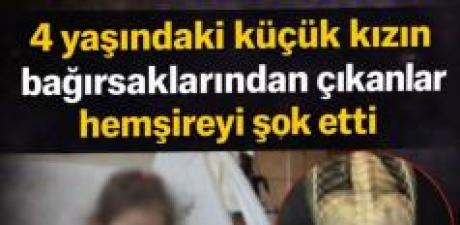4 Yaşındaki Küçük Kızın bağırsağın dan çıkanlar