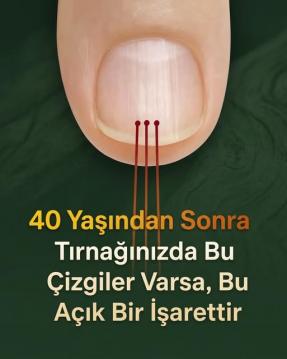 40 Yaşından Sonra Tırnağınızda Çizgiler Varsa