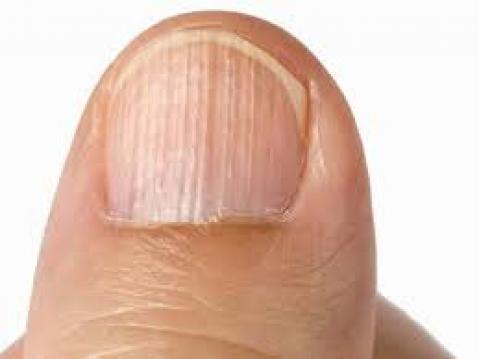 40 Yaşından Sonra Tırnağınızda Çizgiler Varsa