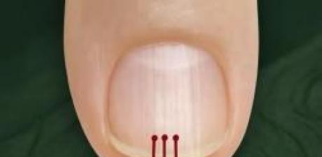 40 Yaşından Sonra Tırnağınızda Çizgiler Varsa