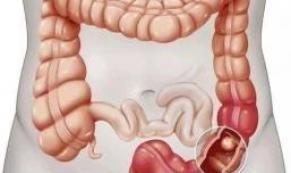 Kolon Kanserinin 5 Belirtisi