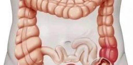 Kolon Kanserinin 5 Belirtisi